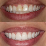 PORCELAIN VENEERS