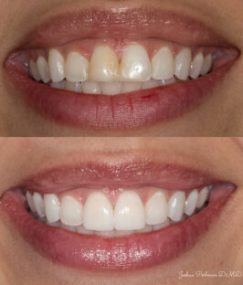 PORCELAIN VENEERS
