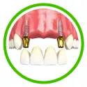 multiple tooth dentures