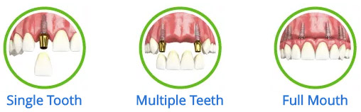 all implant denture types, Full, Multiple Teeth, and single implant