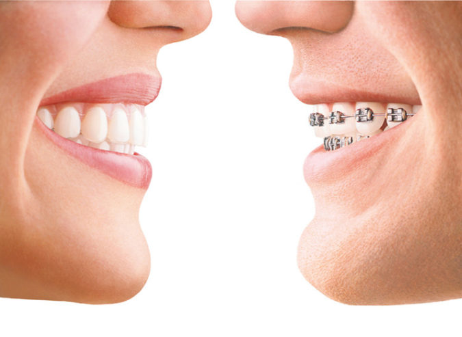 Clear Aligners vs Metal Braces image