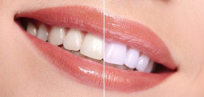 Before and After a teeth whitening
