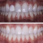 COMBINATION OF WHITENING AND VENEERS