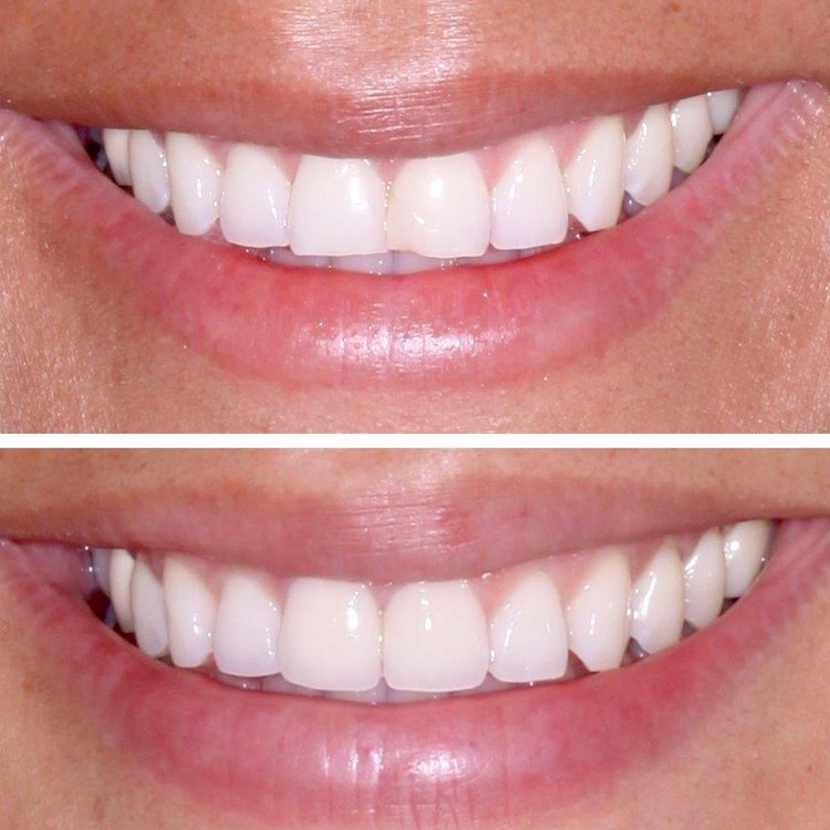 PORCELAIN VENEERS