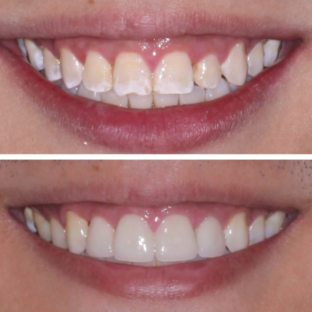 ICON WHITE SPOT REMOVAL, LASER GUM LIFT, AND PORCELAIN VENEERS