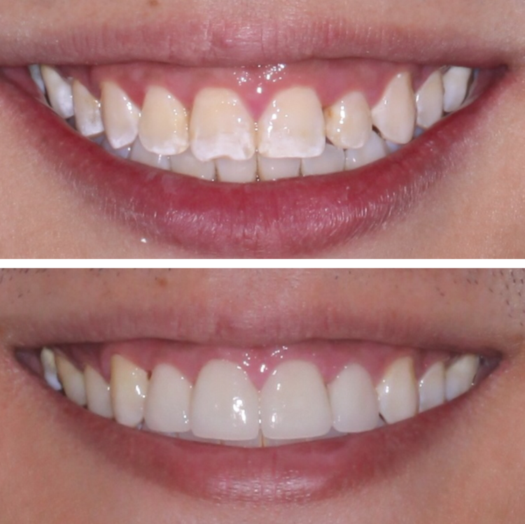 ICON WHITE SPOT REMOVAL, LASER GUM LIFT, AND PORCELAIN VENEERS