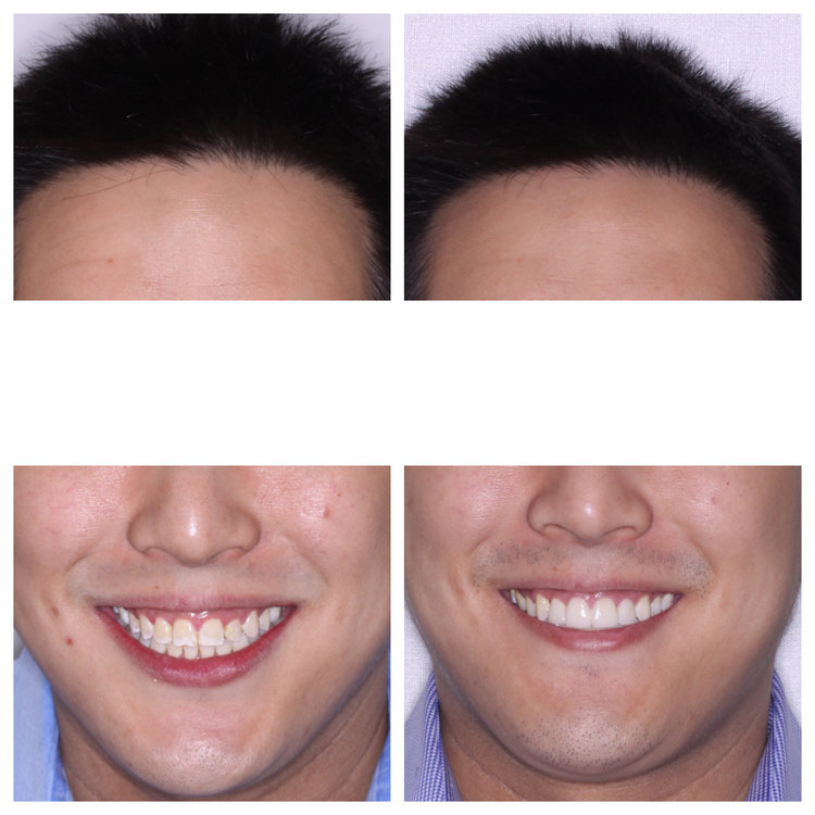 ICON WHITE SPOT REMOVAL, LASER GUM LIFT, AND PORCELAIN VENEERS