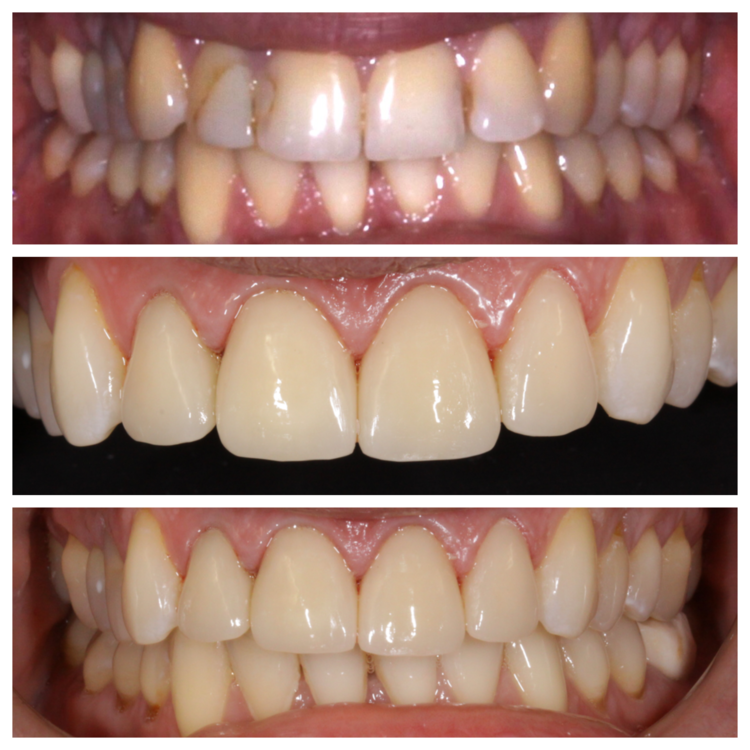REPLACING OLD STAINED BONDING WITH PORCELAIN VENEERS