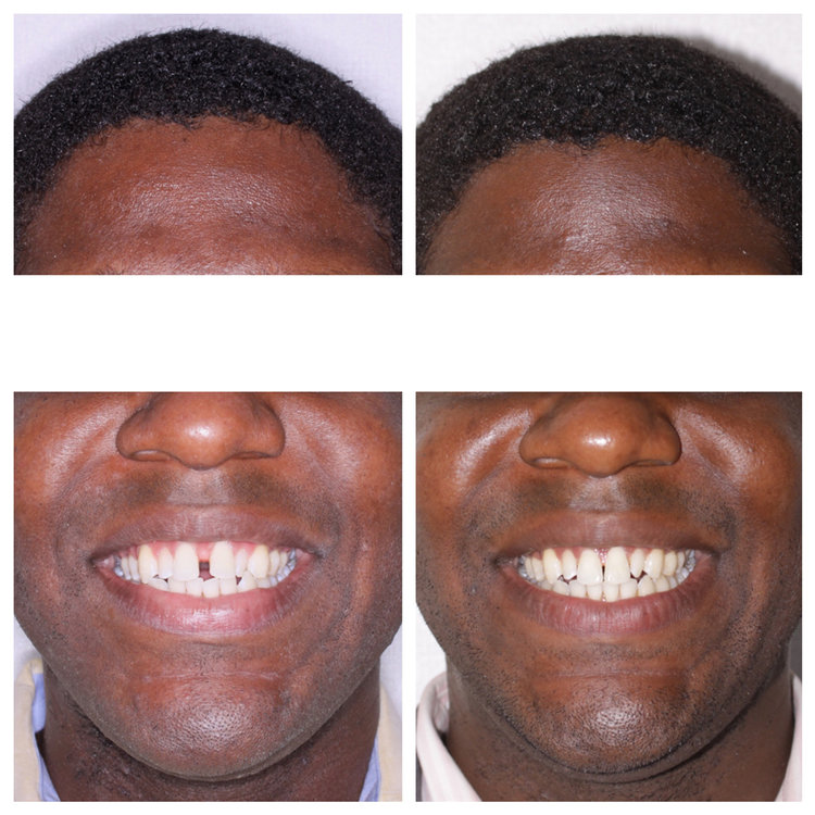 CLOSING LARGE SPACES WITH INVISALIGN