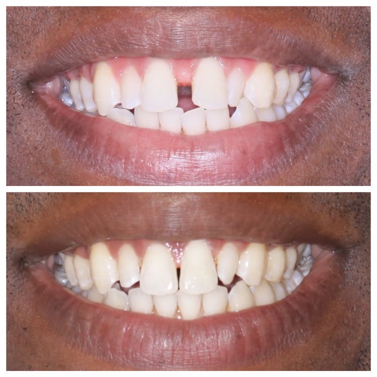 CLOSING LARGE SPACES WITH INVISALIGN