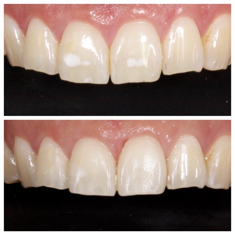ICON WHITE SPOT REMOVAL FROM ORTHODONTICS (THIS PROCEDURE REQUIRES NO INJECTIONS OR DRILLING)