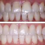 COMBINATION OF WHITENING AND VENEERS