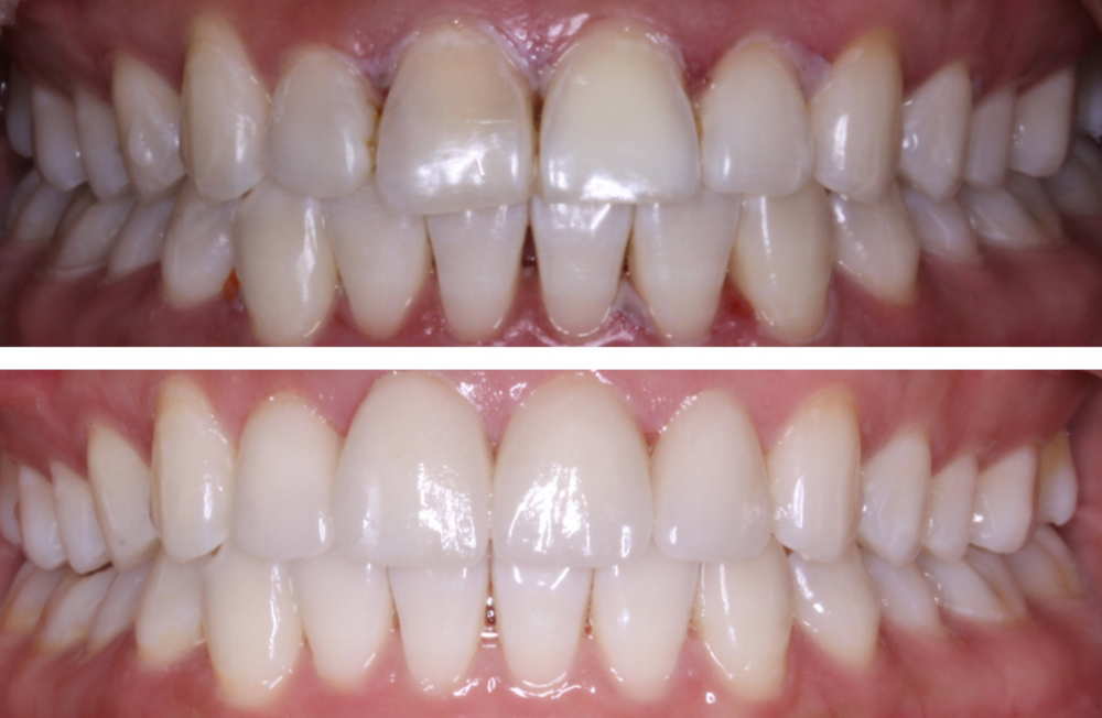 COMBINATION OF WHITENING AND VENEERS