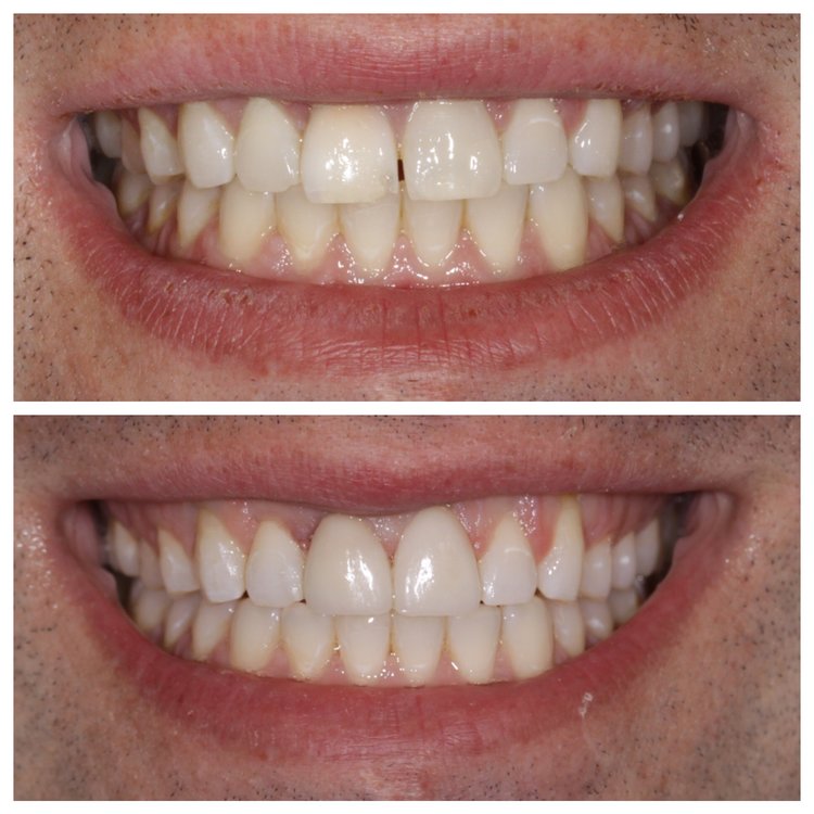 CLOSING GAPS WITH PORCELAIN VENEERS