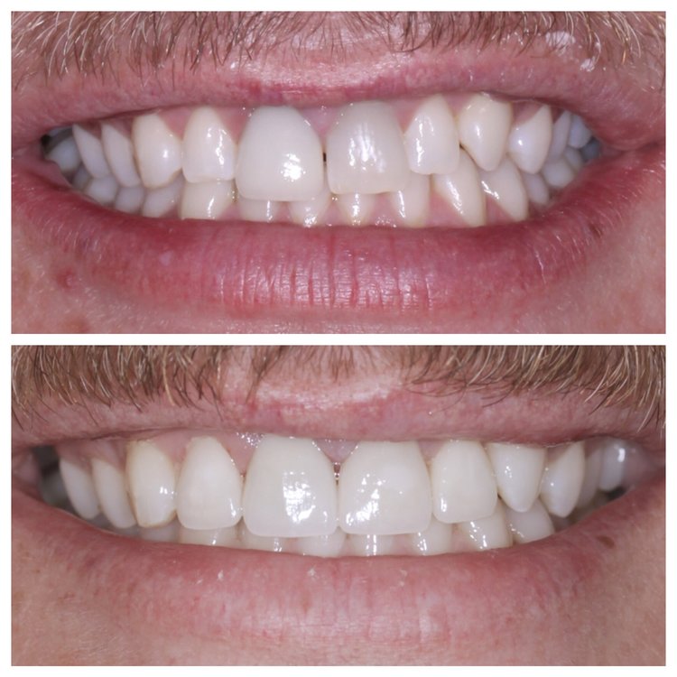 CLOSING GAPS WITH PORCELAIN VENEERS