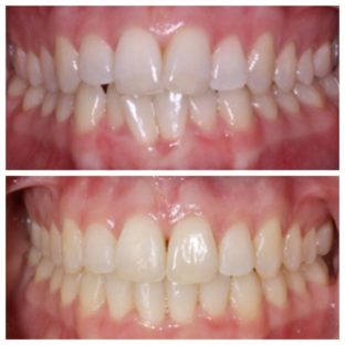 INVISALIGN FOR SEVERE CROWDING