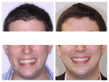 COMPREHENSIVE INVISALIGN TO CREATE A MORE HARMONIOUS SMILE