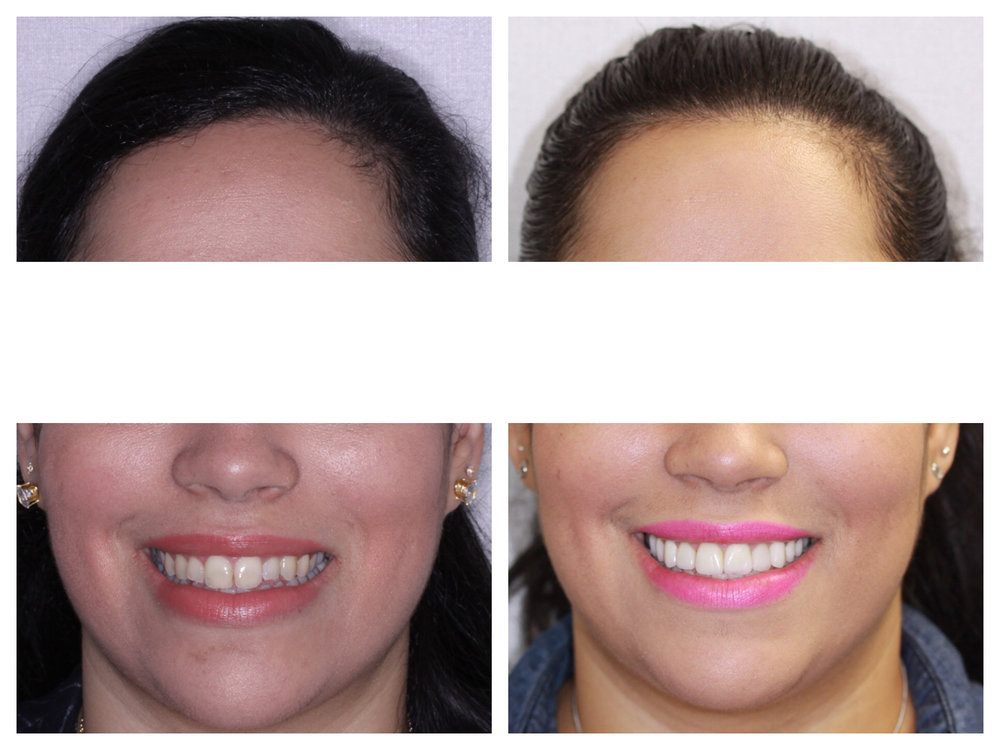 PORCELAIN CROWNS AND VENEERS TO ACHIEVE AN IDEAL SMILE