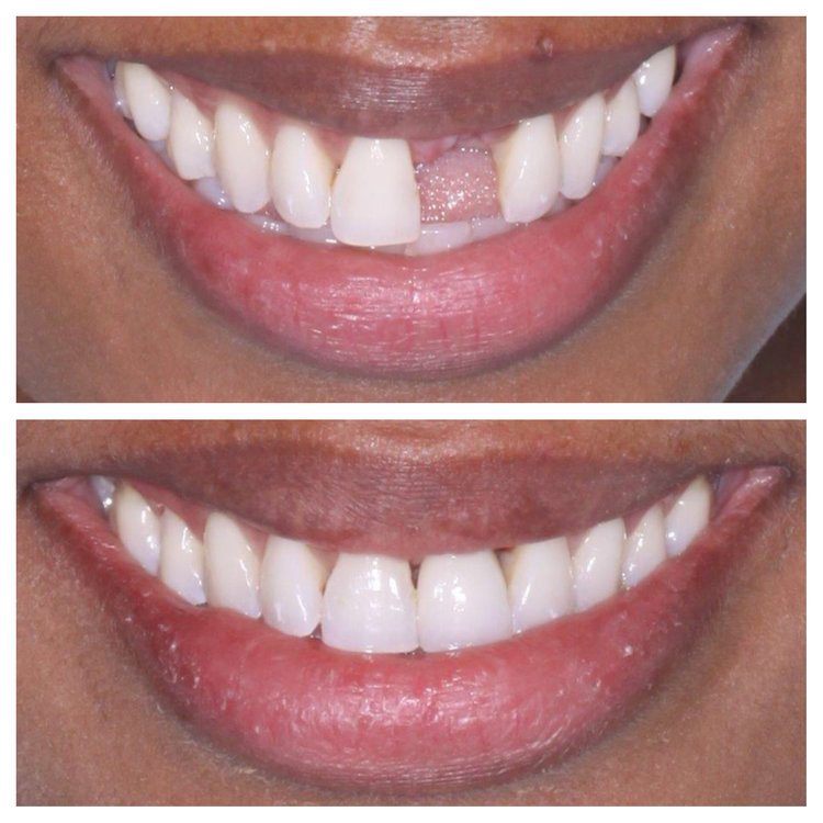 SINGLE TOOTH IMPLANT WITH A CUSTOM SHADE MATCH