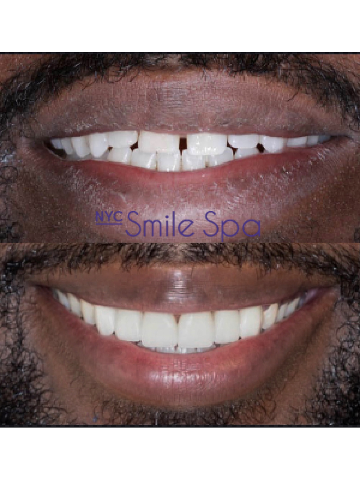 CLOSED SPACES AND TRANSFORMED SMILE WITH PORCELAIN VENEERS