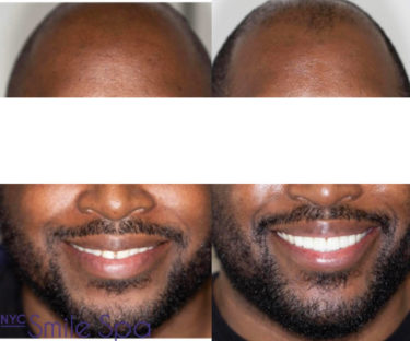 CLOSED SPACES AND TRANSFORMED SMILE WITH PORCELAIN VENEERS
