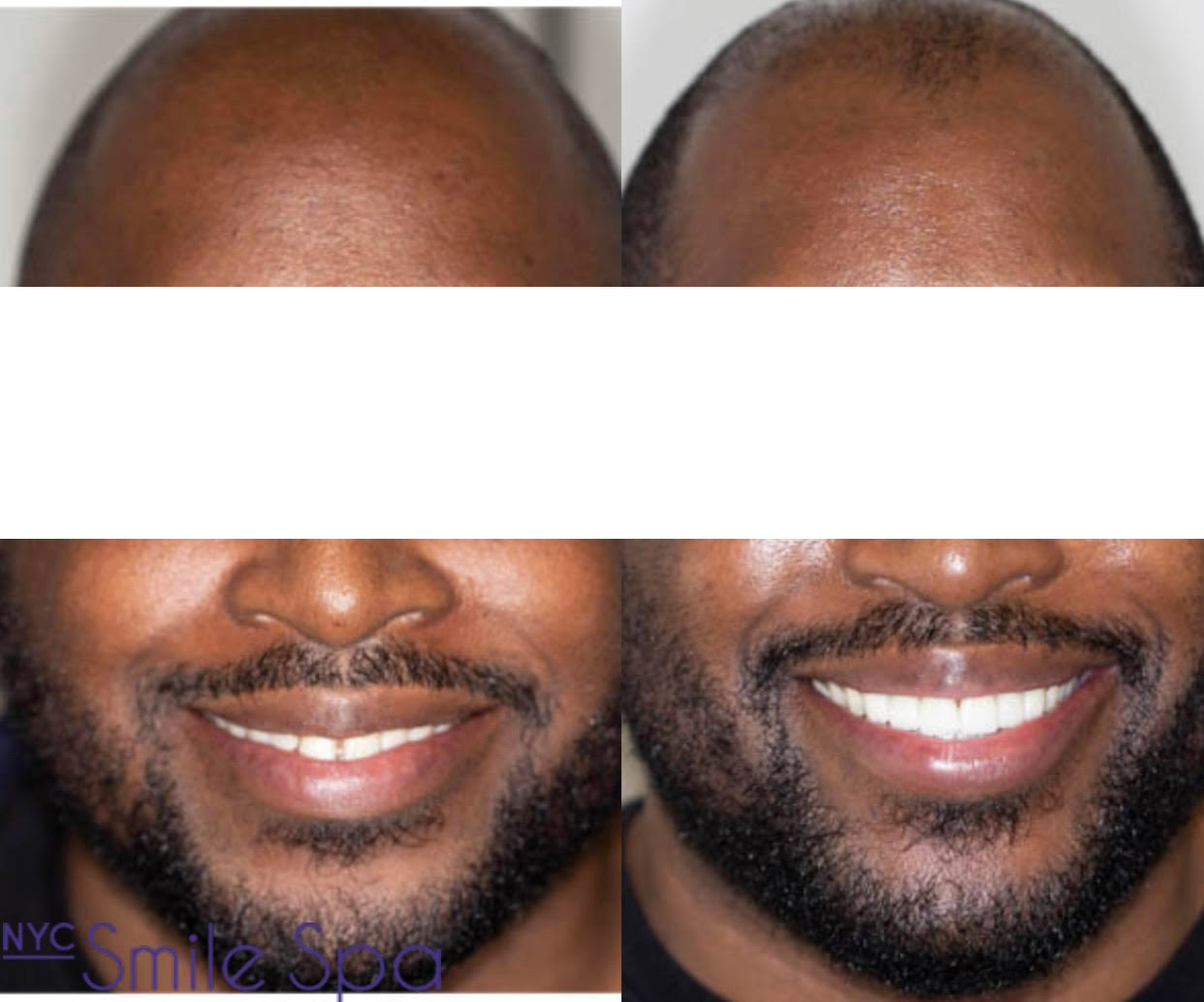 CLOSED SPACES AND TRANSFORMED SMILE WITH PORCELAIN VENEERS