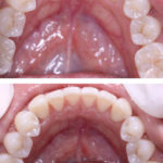 INVISALIGN TO CORRECT TOOTH CROWDING