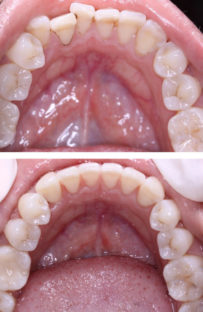 INVISALIGN TO CORRECT TOOTH CROWDING