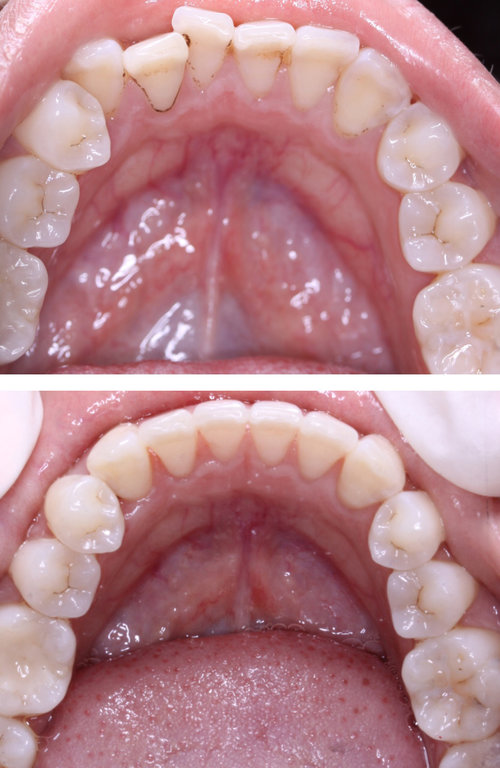 INVISALIGN TO CORRECT TOOTH CROWDING
