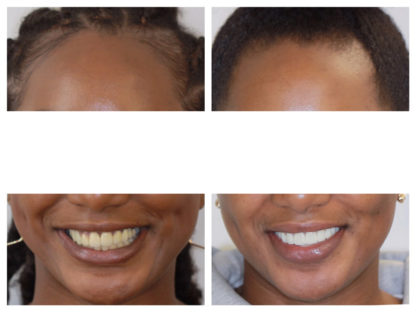 Before and after image