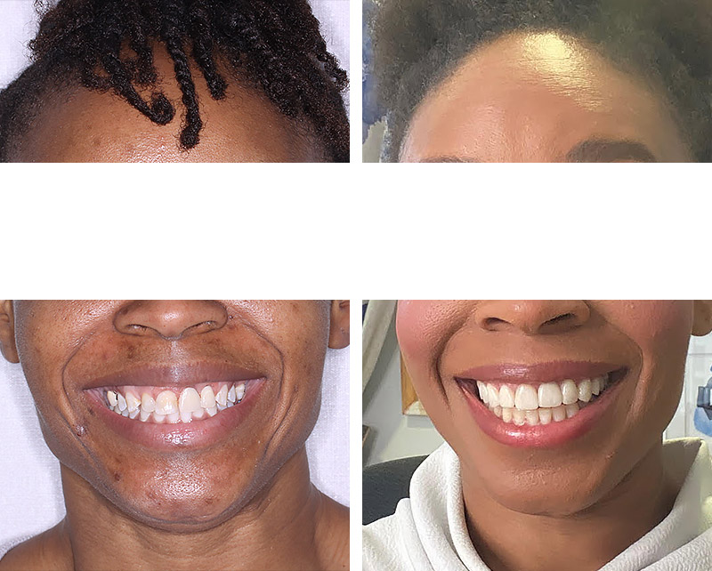 DENTAL IMPLANT AND SMILE MAKEOVER
