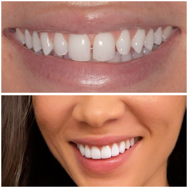 PORCELAIN VENEERS