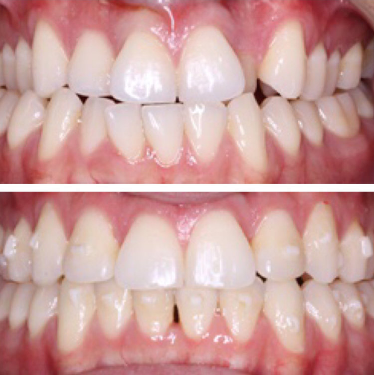 INVISALIGN TO CORRECT TOOTH CROWDING
