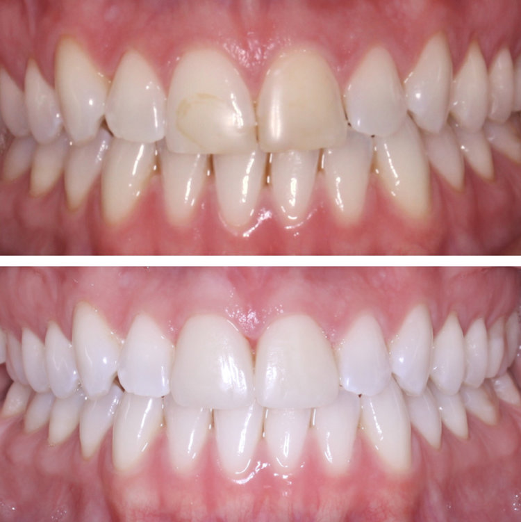 VENEERS AND WHITENING COMBINATION 