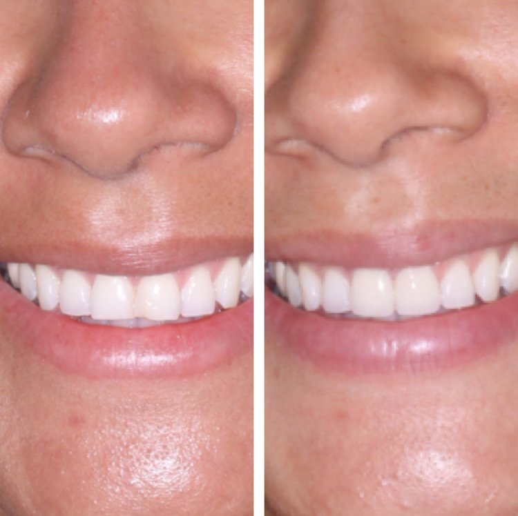 ALL PORCELAIN VENEERS