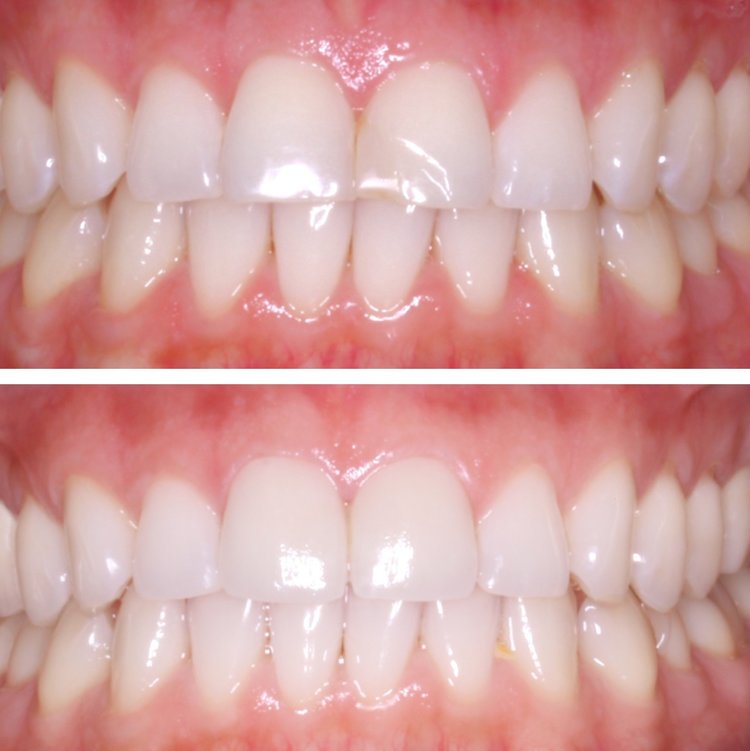 REPLACING OLD BONDING WITH VENEERS