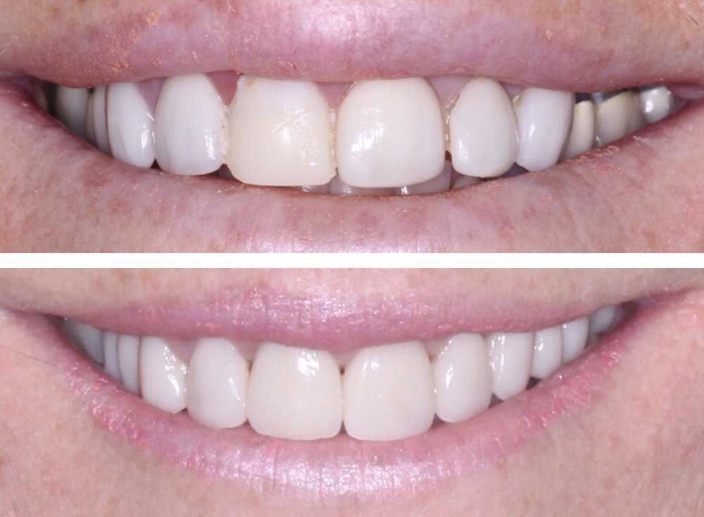 CHANGING OLD LIFELESS VENEERS TO A MORE NATURAL LOOKING SMILE