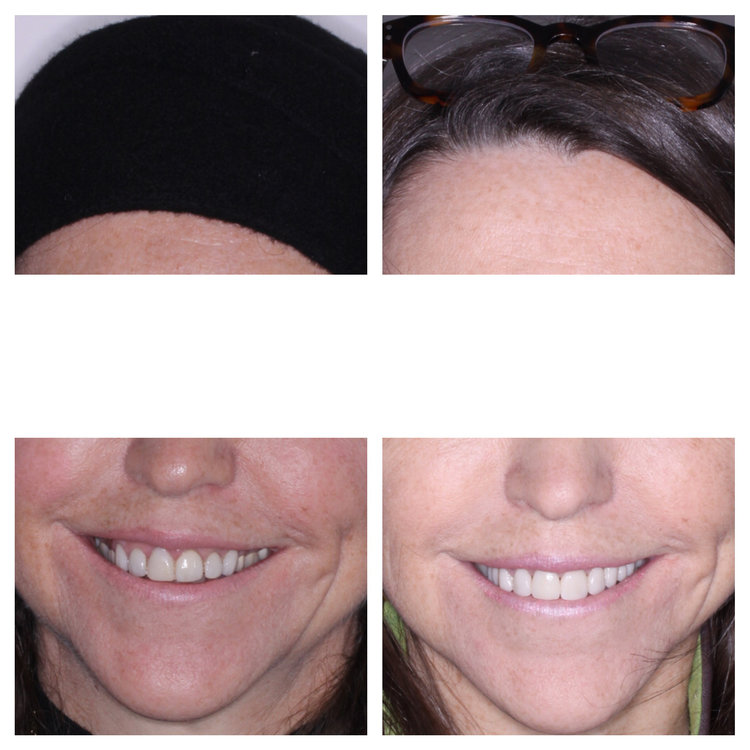 CHANGING OLD LIFELESS VENEERS TO GIVE A MORE NATURAL LOOKING SMILE