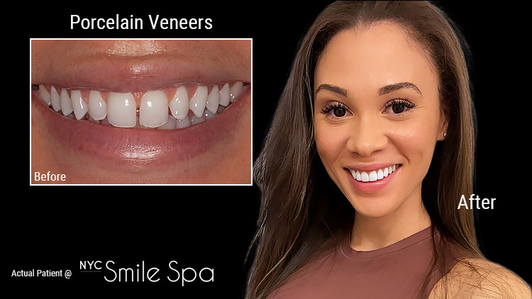 porcelain veneers