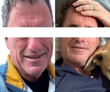 BOTOX BEFORE AND AFTER