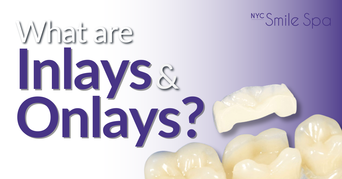 Krochak Blog July 2025 what are inlays and onlays?