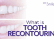 what is tooth recontouring?
