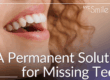 a permanent solution for missing teeth