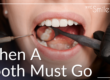 when a tooth must go